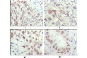 Immunohistochemical analysis of paraffin-embedded human lung carcinoma (A), liver carcinoma (B), breast carcinoma (C) and kiney carcinoma (D), showing nuclear localization with DAB staining using CHK2 mouse mAb.