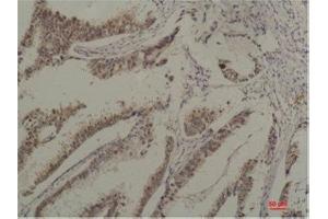 Immunohistochemistry (IHC) analysis of paraffin-embedded Human Breast Carcicnoma using HSC70 Mouse Monoclonal Antibody diluted at 1:200. (Hsc70 antibody)