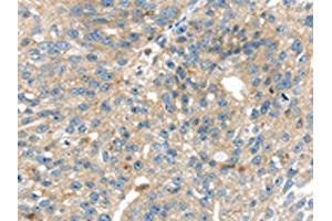 The image on the left is immunohistochemistry of paraffin-embedded Human breast cancer tissue using ABIN7192372(SIGLEC8 Antibody) at dilution 1/25, on the right is treated with synthetic peptide. (SIGLEC8 antibody)