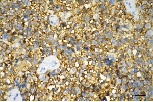 Immunohistochemistry was performed on paraffin-embedded human glioblastoma using growth associated protein 43 antibody (ABIN7798804), 1:200). (Recombinant GAP43 antibody)