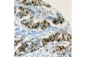Immunohistochemical analysis of RRS1 staining in human colon cancer formalin fixed paraffin embedded tissue section. (RRS1 antibody)