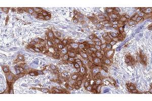 ABIN6277066 at 1/100 staining Human Head and neck cancer tissue by IHC-P. (GNA15 antibody  (C-Term))