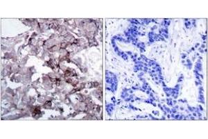 Immunohistochemistry analysis of paraffin-embedded human breast carcinoma tissue, using EGFR (Ab-1172) Antibody.