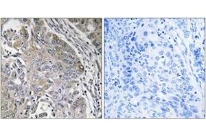 Immunohistochemistry analysis of paraffin-embedded human lung carcinoma, using SPINK6 Antibody. (SPINK6 antibody  (AA 13-62))