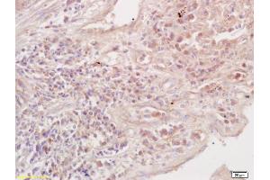 Formalin-fixed and paraffin embedded Human Lung Carcinoma labeled with Anti-Transferrin receptor Polyclonal Antibody, Unconjugated (ABIN734378) at 1:200 followed by conjugation to the secondary antibody and DAB staining (Transferrin Receptor antibody  (AA 21-120))