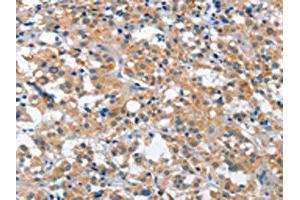 The image is immunohistochemistry of paraffin-embedded human thyroid cancer tissue using ABIN7129101(CUL7 Antibody) at dilution 1/35. (Cullin 7 antibody)