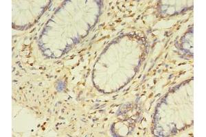 Immunohistochemistry of paraffin-embedded human colon cancer using ABIN7163017 at dilution of 1:100 (ETHE1 antibody  (AA 8-254))