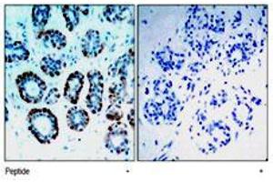 Immunohistochemical analysis of paraffin-embedded human breast carcinoma tissue, using Bsx polyclonal antibody . (BSX antibody  (N-Term))