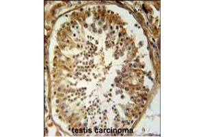 SRAC1 Antibody (C-term) (ABIN654755 and ABIN2844439) immunohistochemistry analysis in formalin fixed and paraffin embedded human testis carcinoma followed by peroxidase conjugation of the secondary antibody and DAB staining. (SERAC1 antibody  (C-Term))