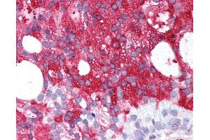 Anti-RXFP1/ LGR7 antibody IHC of human Prostate, Carcinoma. (RXFP1 antibody  (C-Term))