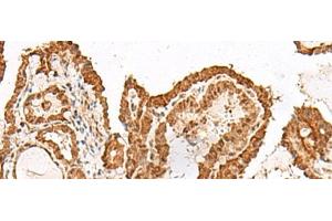 Immunohistochemistry of paraffin-embedded Human thyroid cancer tissue using GRASP Polyclonal Antibody at dilution of 1:150(x200) (Tamalin/GRASP antibody)