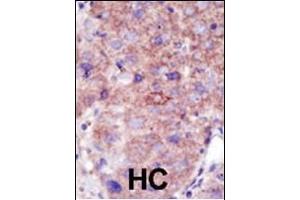 Formalin-fixed and paraffin-embedded human cancer tissue reacted with the primary antibody, which was peroxidase-conjugated to the secondary antibody, followed by DAB staining. (SMURF2 antibody  (C-Term))