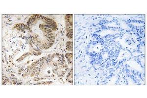 Immunohistochemistry analysis of paraffin-embedded human colon carcinoma tissue using PIK3R5 antibody. (PIK3R5 antibody  (C-Term))