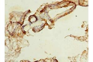 Immunohistochemistry of paraffin-embedded human breast cancer using ABIN7161118 at dilution of 1:100 (NDFIP1 antibody  (AA 2-116))