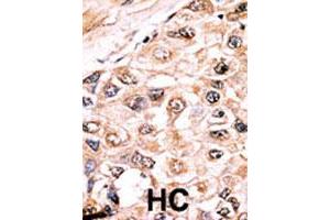 Formalin-fixed and paraffin-embedded human hepatocellular carcinoma tissue reacted with ACVR1 polyclonal antibody  , which was peroxidase-conjugated to the secondary antibody, followed by AEC staining. (ACVR1 antibody  (Internal Region))