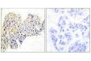 Immunohistochemical analysis of paraffin-embedded human breast carcinoma tissue using HSP90B (Ab-254) antibody. (HSP9AB1 (Ser254) antibody)