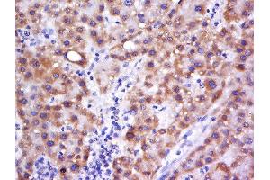 Paraformaldehyde-fixed, paraffin embedded human liver cancer, Antigen retrieval by boiling in sodium citrate buffer (pH6) for 15min, Block endogenous peroxidase by 3% hydrogen peroxide for 30 minutes, Blocking buffer (normal goat serum) at 37°C for 20min, Antibody incubation with Rabbit Anti-C6orf222 Polyclonal Antibody, Unconjugated  at 1:500 overnight at 4°C, followed by a conjugated secondary and DAB staining.