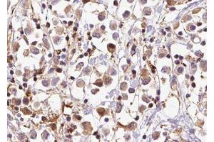 ABIN6279656 at 1/100 staining Human breast cancer tissue by IHC-P. (PIGP antibody)