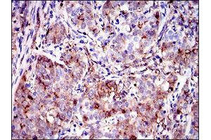 Immunohistochemical analysis of paraffin-embedded cervical cancer tissues using ANXA1 mouse mAb with DAB staining. (Annexin a1 antibody  (AA 144-248))