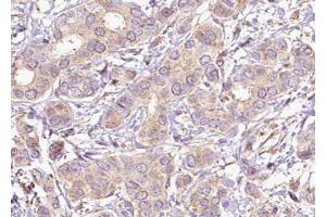 ABIN6267621 at 1/100 staining human Breast carcinoma tissue sections by IHC-P. (PTPN11 antibody  (pTyr542))
