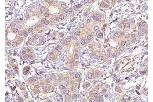 ABIN6267621 at 1/100 staining human Breast carcinoma tissue sections by IHC-P.