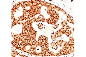 IHC testing of breast cancer stained with Estrogen Receptor beta antibody (ERb455).