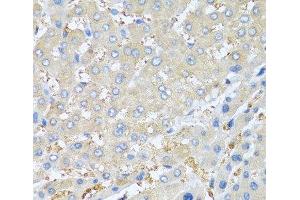 Immunohistochemistry of paraffin-embedded Human liver cancer using PPBP Polyclonal Antibody at dilution of 1:100 (40x lens). (CXCL7 antibody)