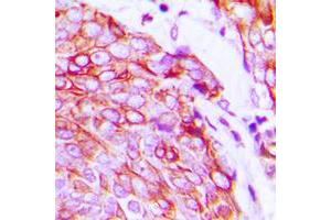 Immunohistochemical analysis of VEGFR2 (pY1175) staining in human breast cancer formalin fixed paraffin embedded tissue section.