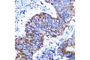 Immunohistochemistry of paraffin-embedded human colon carcinoma using COX IV Rabbit mAb (ABIN7266641) at dilution of 1:100 (40x lens). (COX IV antibody)
