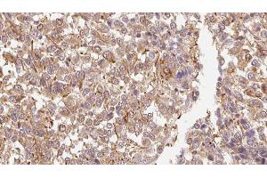 ABIN6278858 at 1/100 staining Human Melanoma tissue by IHC-P.