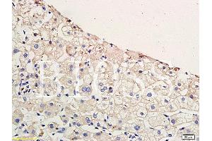Formalin-fixed and paraffin embedded human hepatitides tissue labeled with Anti-CCR4 Polyclonal Antibody, Unconjugated (ABIN738666) at 1:200 followed by conjugation to the secondary antibody and DAB staining (CCR4 antibody  (AA 201-300))