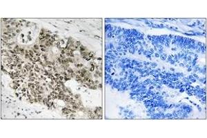 Immunohistochemistry analysis of paraffin-embedded human colon carcinoma, using ATR (Ab-428) Antibody. (ATR antibody  (AA 394-443))