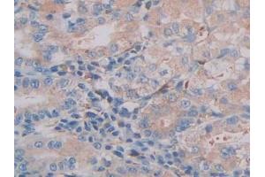 DAB staining on IHC-P; Samples: Human Stomach cancer Tissue (CTSC antibody  (AA 231-463))