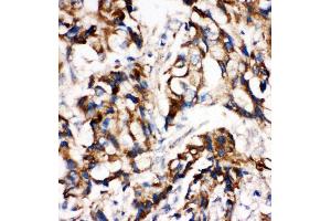 Anti-MEK1 antibody, IHC(P) IHC(P): Human Mammary Cancer Tissue (MEK1 antibody  (C-Term))