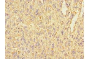 Immunohistochemistry of paraffin-embedded human melanoma using ABIN7174844 at dilution of 1:100 (C3ORF36 antibody  (AA 1-165))