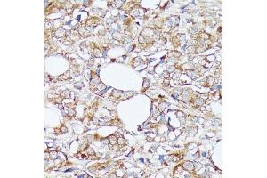 Immunohistochemistry of paraffin-embedded human mammary cancer using SLC7 antibody (ABIN7270481) at dilution of 1:100 (40x lens). (SLC7A2 antibody  (C-Term))
