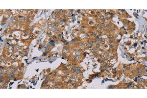 Immunohistochemistry of paraffin-embedded Human thyroid cancer using TAB3 Polyclonal Antibody at dilution of 1:35 (TAB3 antibody)