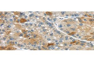 Immunohistochemistry of paraffin-embedded Human liver cancer using UPP2 Polyclonal Antibody at dilution of 1/35 (UPP2 antibody)