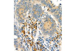 Immunohistochemistry of paraffin embedded human colon cancer using P4H (ABIN7074215) at dilution of 1:700 (400x lens) (HIF Prolyl Hydroxylase antibody)