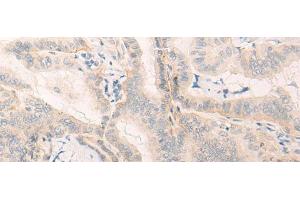 Immunohistochemistry of paraffin-embedded Human thyroid cancer tissue using ELANE Polyclonal Antibody at dilution of 1:25(x200) (ELANE antibody)