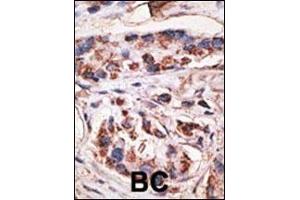 Formalin-fixed and paraffin-embedded human cancer tissue reacted with the primary antibody, which was peroxidase-conjugated to the secondary antibody, followed by DAB staining. (MAGEA1 antibody  (AA 143-173))