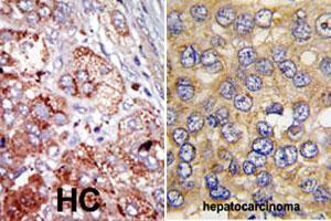 Formalin-fixed and paraffin-embedded human hepatocellular carcinoma tissue reacted with PFKFB4 polyclonal antibody  , which was peroxidase-conjugated to the secondary antibody, followed by AEC staining. (PFKFB4 antibody  (Internal Region))