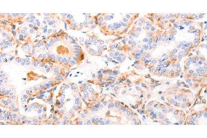 Immunohistochemistry of paraffin-embedded Human thyroid cancer using ABCA4 Polyclonal Antibody at dilution of 1:30 (ABCA4 antibody)
