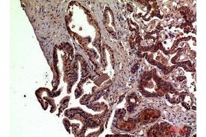 Immunohistochemistry (IHC) analysis of paraffin-embedded Human Prostate Cancer, antibody was diluted at 1:100. (RSAD2 antibody  (Internal Region))