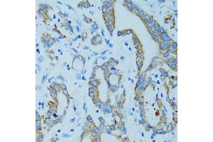Immunohistochemistry of paraffin-embedded human colon carcinoma using KRT15 antibody (ABIN5971439) at dilution of 1/100 (40x lens).