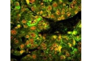 Immunofluorescence analysis of CD38 antibody with paraffin-embedded human hepatocarcinoma tissue. (CD38 antibody  (AA 241-270))