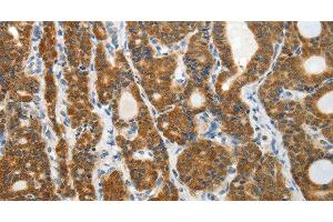 Immunohistochemistry of paraffin-embedded Human thyroid cancer tissue using PRDX5 Polyclonal Antibody at dilution 1:40 (Peroxiredoxin 5 antibody)