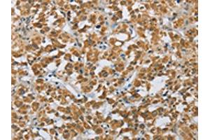 The image on the left is immunohistochemistry of paraffin-embedded Human thyroid cancer tissue using ABIN7190689(FOXF1 Antibody) at dilution 1/25, on the right is treated with synthetic peptide. (FOXF1 antibody)