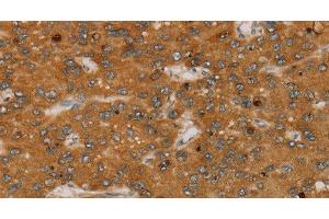 Immunohistochemistry of paraffin-embedded Human liver cancer tissue using PARP3 Polyclonal Antibody at dilution 1:40 (PARP3 antibody)