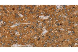 Immunohistochemistry of paraffin-embedded Human liver cancer tissue using PARP3 Polyclonal Antibody at dilution 1:40 (PARP3 antibody)